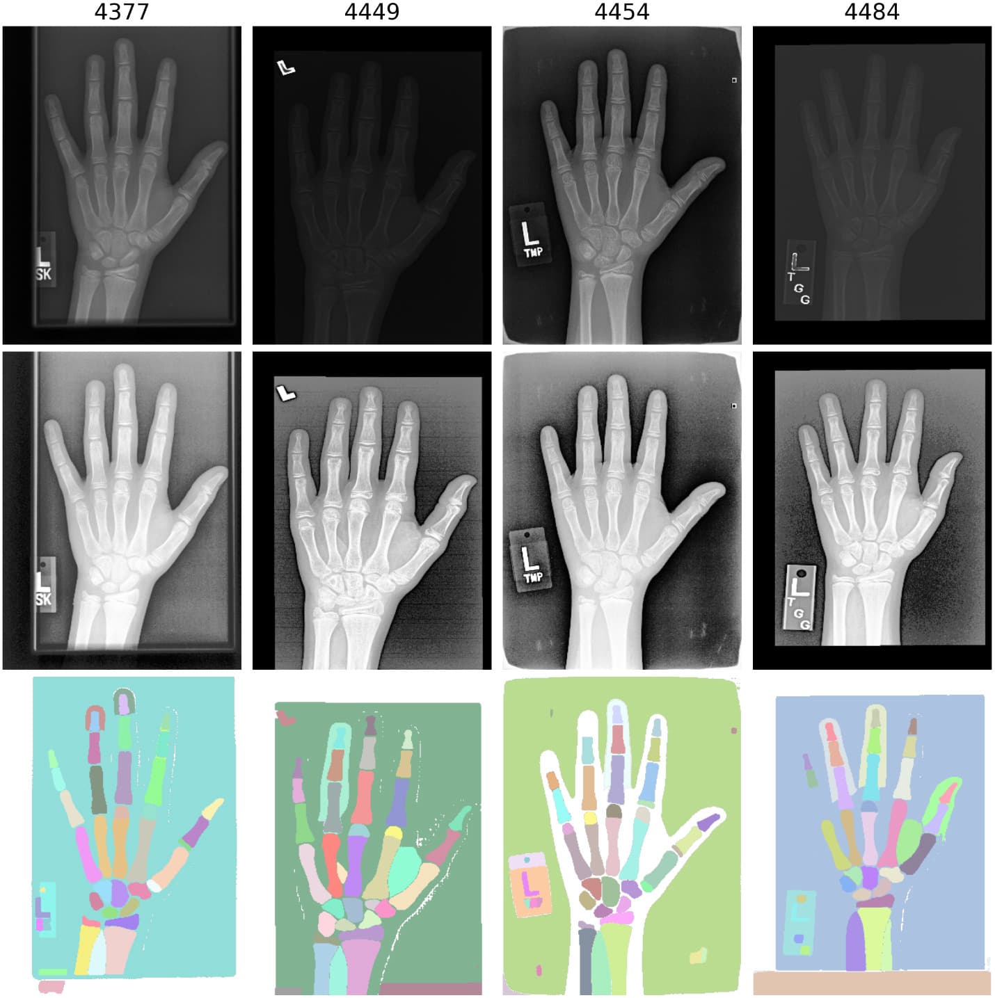 Hand X-ray segmentation pipeline using SAM